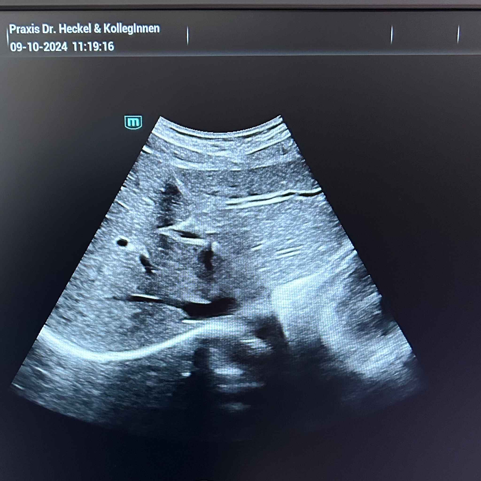 Ultraschallbild während einer Abdomensonografie